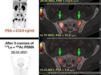Change of PSA values in dynamics with the intensity of PSMA accumulation