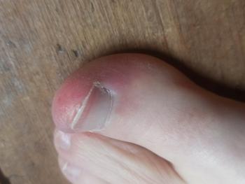 Red swollen toe