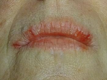 angular cheilitis mainly affecting the corners of your mouth 
