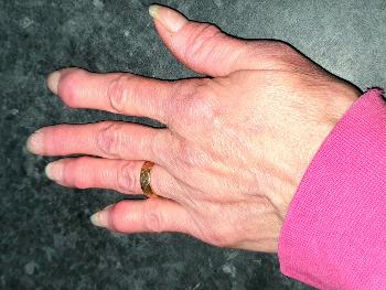 View of erosive finger arthritis 