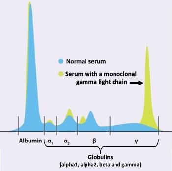 Serum protein electrophoresis to identify a monoclonal serum light chain