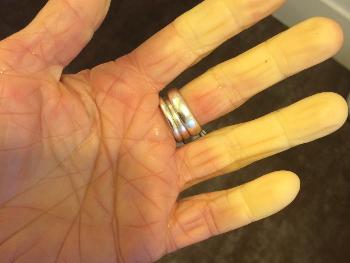 Raynauds in all fingers - white stage (no blood)