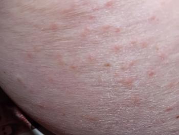 red spots on leg