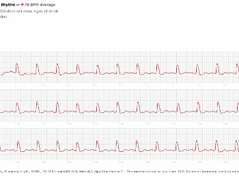 ECG from Apple Watch showing "wide QRS" from LBBB.