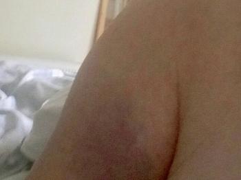 bruised arm