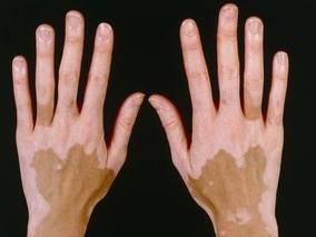 Hands affected by Vitiligo, AI disease of pigmentation.