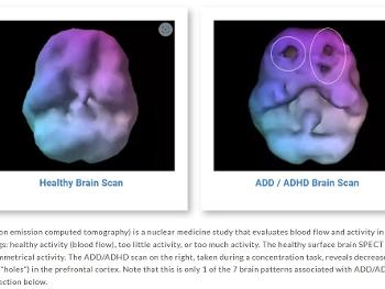 Normal Brain scan versus ADHD Brain scan