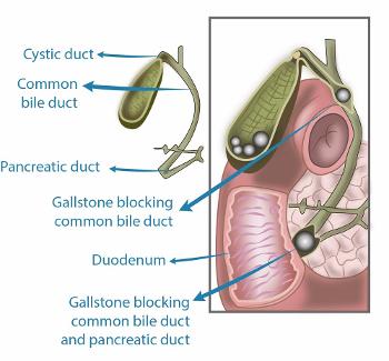 Gallstones in the common bile duct