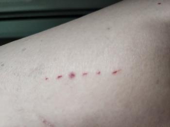 Cat scratch 