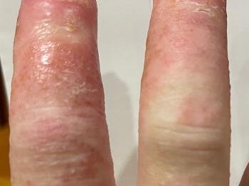 Chilblain with Fingertip Ulcers