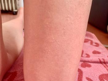 Leg with odd pattern of goosebumps on thigh