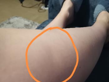 Picture of my leg not sure it's clear but there's definitely a dent or dip not sure why? 