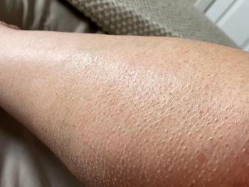 Patches of goosebumps