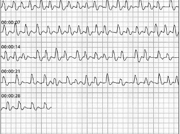 ECG showing AF