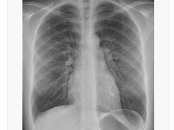 Normal chest X-ray 