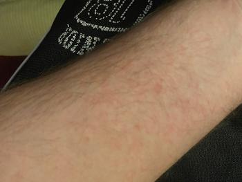 Red blotches on arm