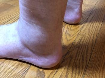 foot with edema