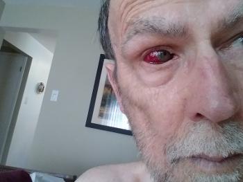 Prednisone induced bloody eye