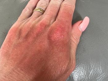 My hands are both like this with a little white peeling on them 