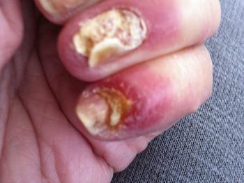 Nails at their worst