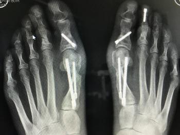 Bilateral bunionectomy and toe shortening