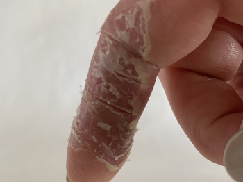 Peeling fingers