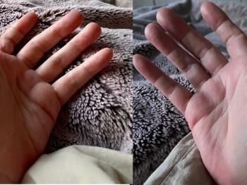 Colour photo of Erythromelalgia in my hands this morning 