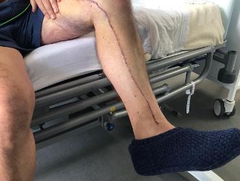 Leg wound after four days 