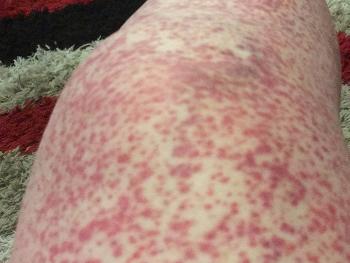 Leg completely covered in angry red rash called HS Purpura