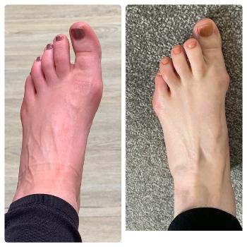 Foot during EM flare up and foot normal colour. 