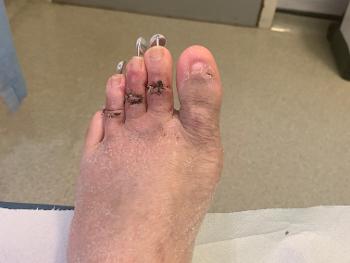 Foot following claw toe surgery at 2 week follow up.