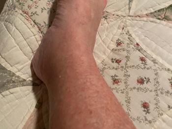 My leg/foot allergic reaction to Amantadine 