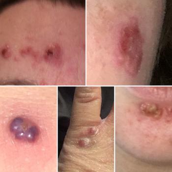 Photos of skin lesions 
