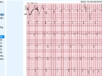 ECG with Sidebar of events