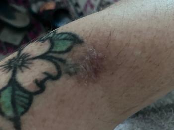 Today Sept 2024. Never healing sore. After ivermectin paste in it for two days. 