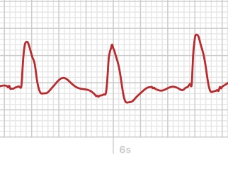 Apple Watch ECG showing bundle block with wide QRS.