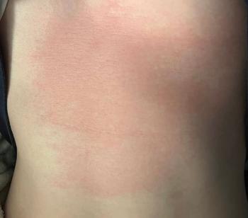 Red itchy patches appear on body and face